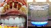 Formule Secr Te De Dentiste Chinois Enlever La Plaque Dentaire En 2 Minutes Avec Ce Rince Bouche